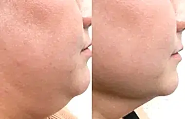 Amilyatsız yüz germe