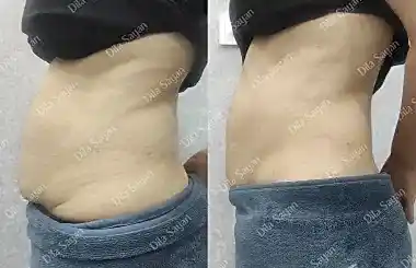 Bölgesel zayıflama