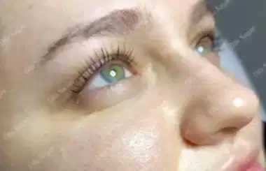 Kirpik lifting işlemi