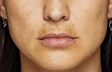 Cilt Lekeleri Neden Olur? Nasıl Geçer?